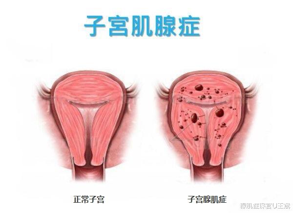 腺肌症保宫U王斌|身上同时出现这3个症状，基本能确诊子宫腺肌症！