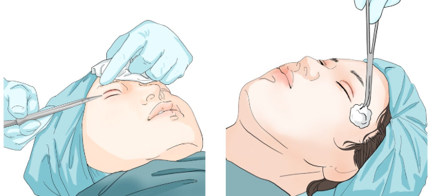 史迎军眼整形|史迎军眼整形 | 双眼皮术后5问，想做双眼皮还不快来了解一下