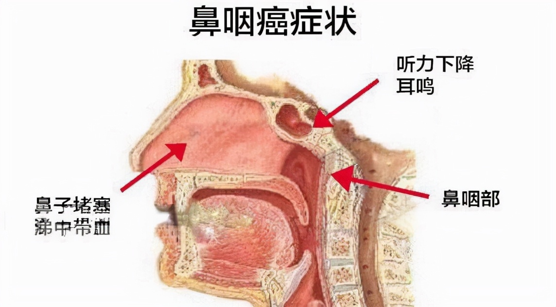 用户_胡洋 中式咸鱼被世界卫生组织列入一级致癌物清单中，与多种癌症相关