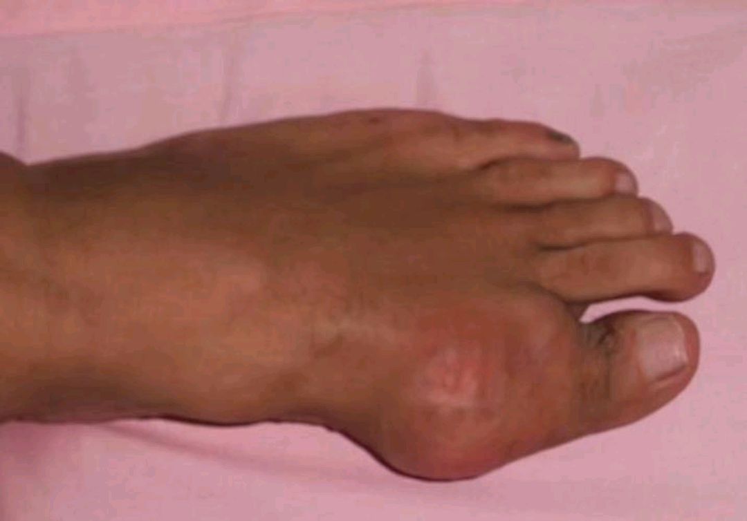 痛风|提醒大家：若关节处有3种异常信号，警惕被痛风找上门，及时调理