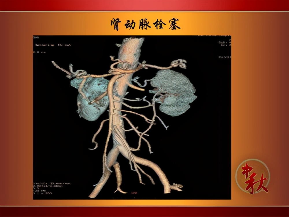 静脉血栓形成|小儿肾静脉血栓形成，会引起全部肾静脉阻塞，成年人常发生肺栓塞