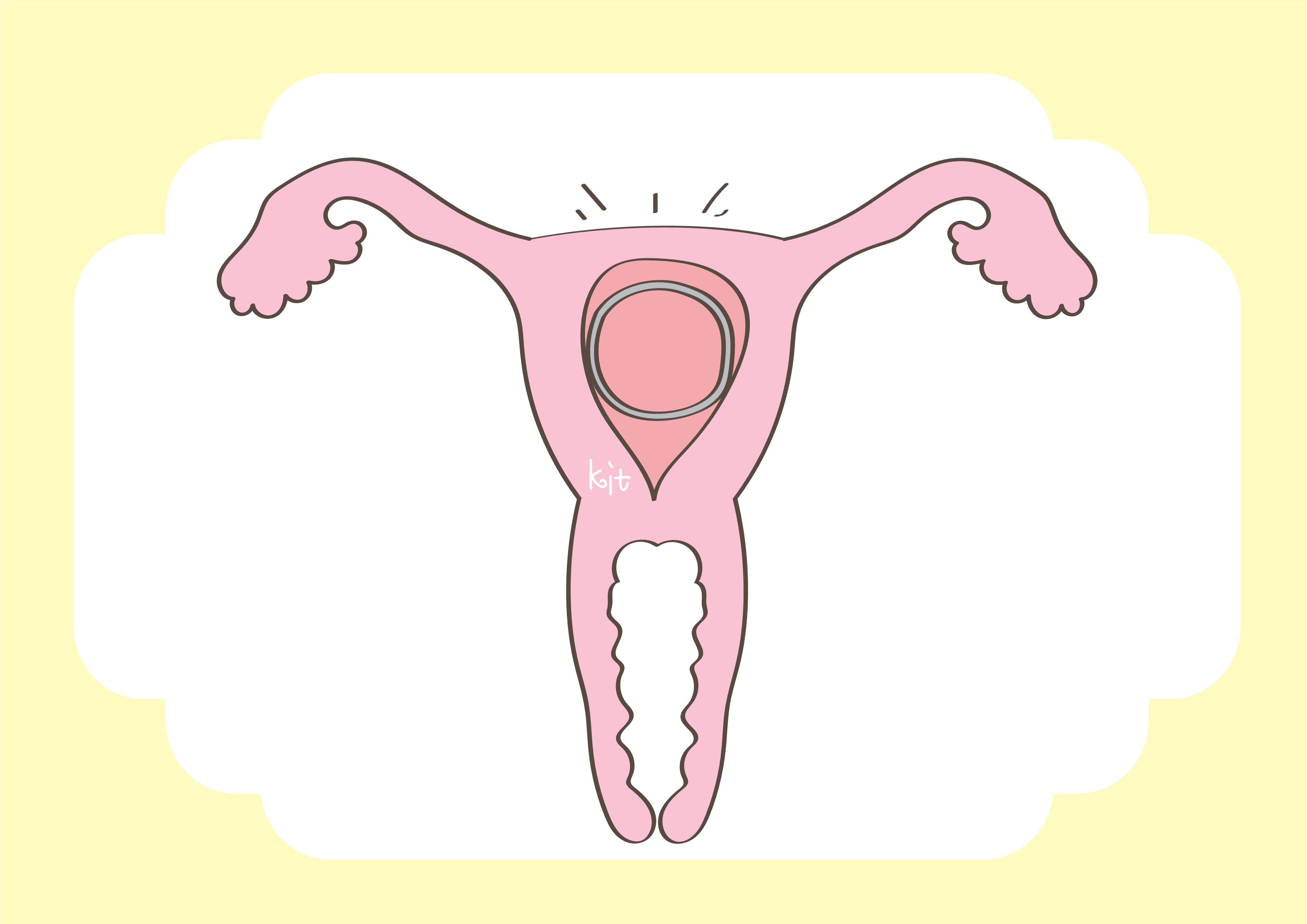 月叔育儿说|节育环放进子宫内后，还需要取出来吗？答案和一般人认知不同