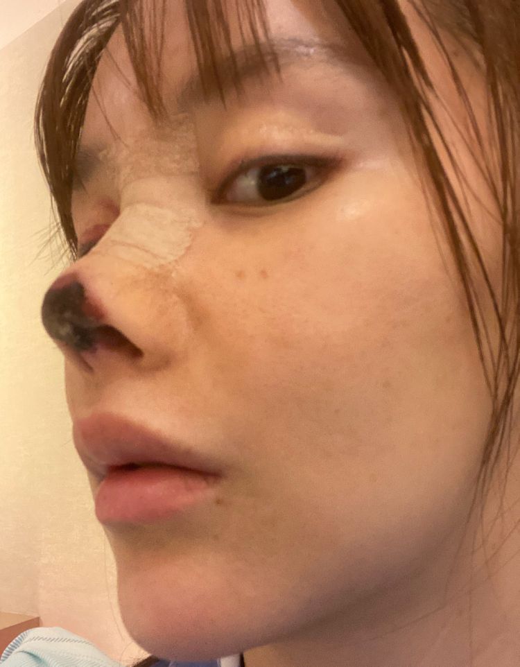 整容|演员高溜整容失败，鼻头坏死触目惊心，曾多次想自杀：整容需谨慎