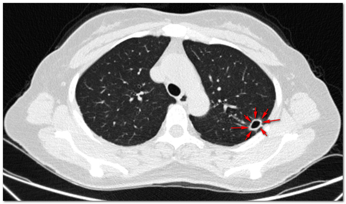 用户_胡洋|女病人被误认为结核差点被逼疯,其实是结核菌的“小兄弟”感染