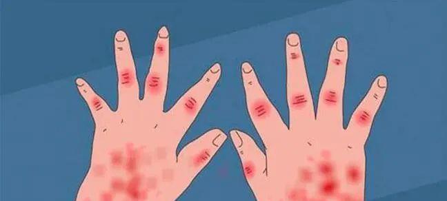 系统性红斑狼疮 干细胞治疗系统性红斑狼疮临床疗效亮眼