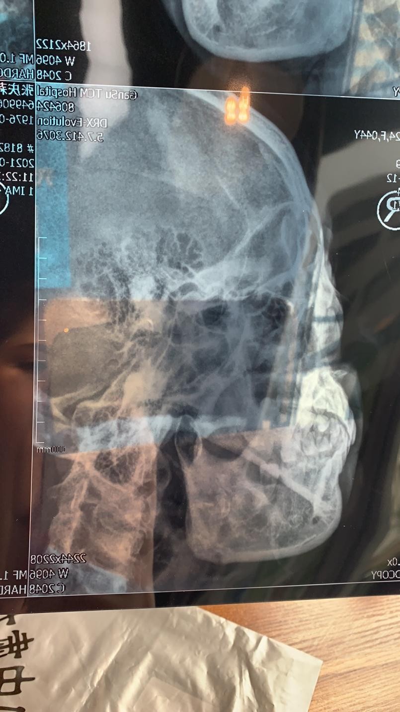 李家人翻译 焕颜“整骨”后的噩梦