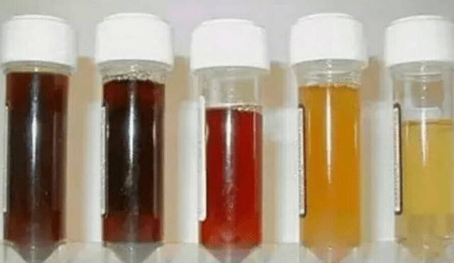 肝脏|肝不好的人,上厕所时会出现3种现象,若你有,劝你最好查肝CT