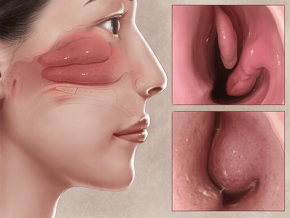 慢性鼻炎|?预防慢性鼻炎的发生,冬季需做好哪些预防工作?