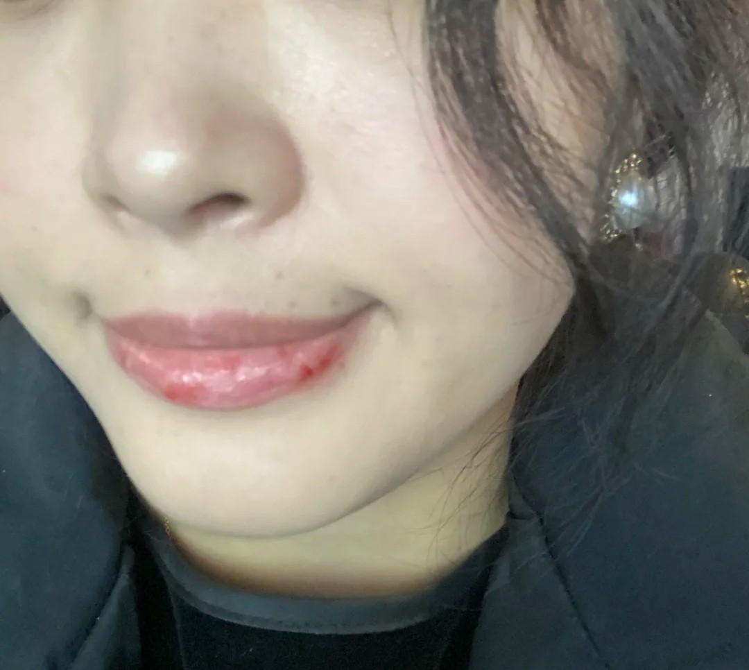 润唇膏 口水护唇?手撕嘴皮?唇炎?救星来了!这5款孕妇润唇膏了解一下