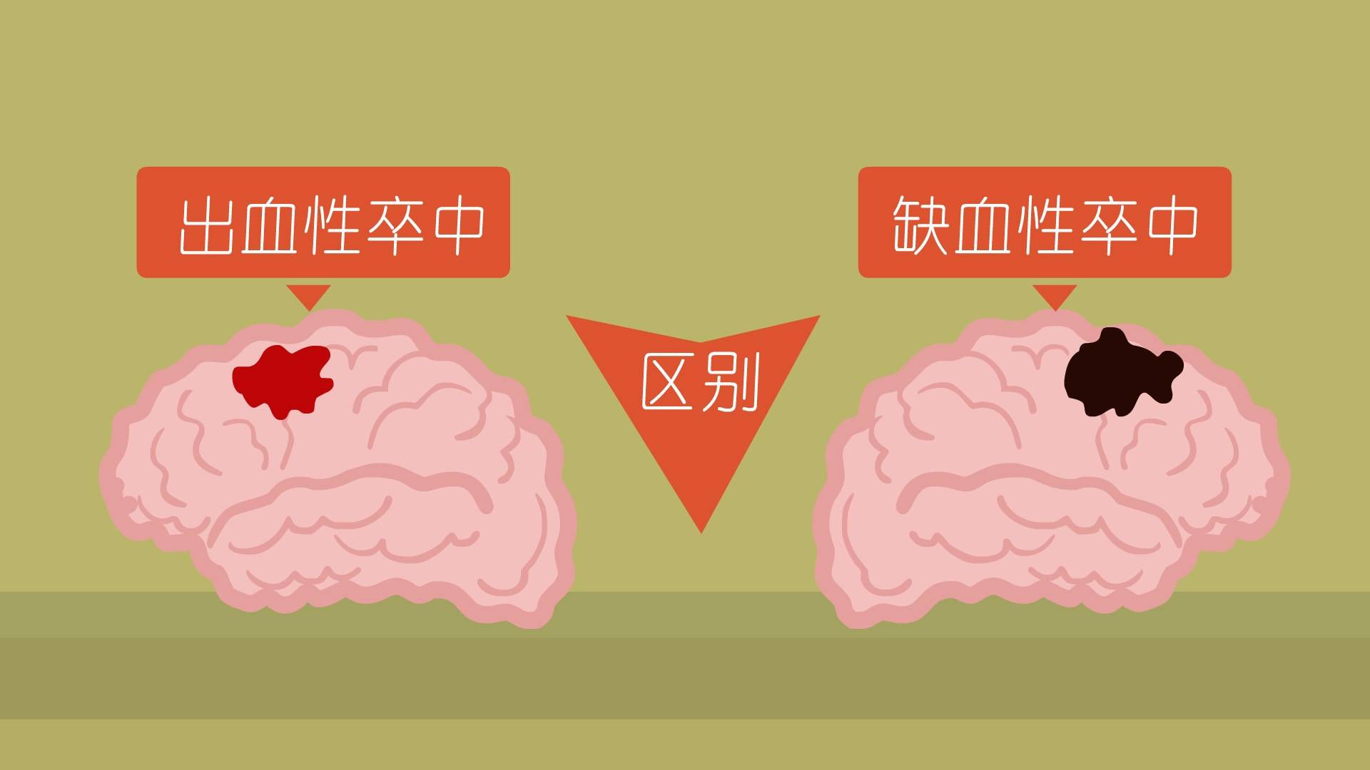 脑卒中|两个案例：神经干细胞移植对治疗卒中的临床疗效评估