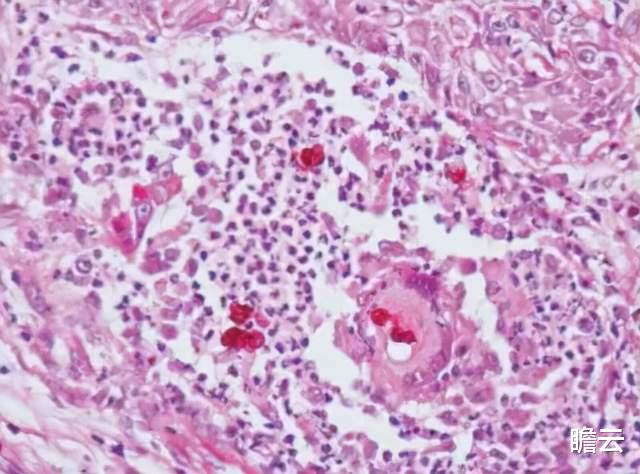 狂犬病|你的大脑是如何被狂犬病毒一口一口吃掉的？