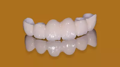 牙齿|牙齿严重龋坏、缺损?现代化修复方式了解一下(一)