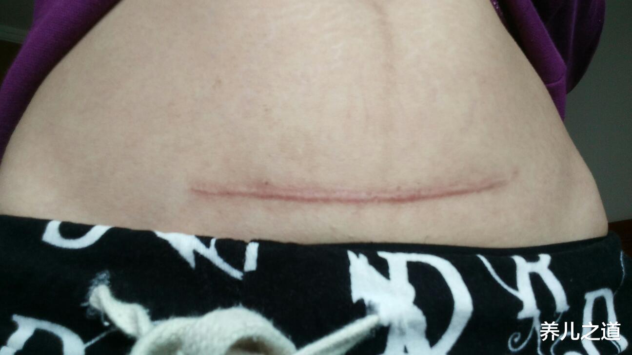 养儿之道|剖腹产横切和纵切有什么区别？打算剖腹产的孕妇，要认真做选择