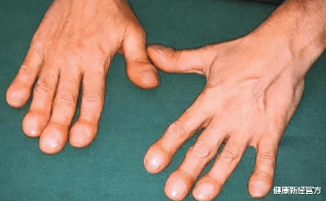 痛风|35岁大叔因患痛风，截肢保命，医生叹息：3类食物再喜欢，也要忌口