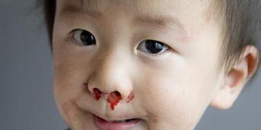 我是妈妈|3岁女童流鼻血，家长一个习惯性动作差点引发窒息，别再踩坑了