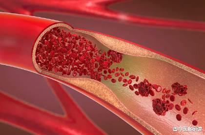 高血脂|高血脂“祸根”不只是油,医生提醒:3种食物再吃,血液粘稠如粥