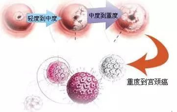 祥光堂|内裤上若出现这“变化”，可能是HPV的“预兆”，千万别忽略了！