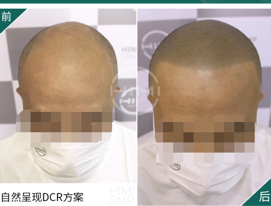 肝脏|冬季护发防脱，要注意什么？