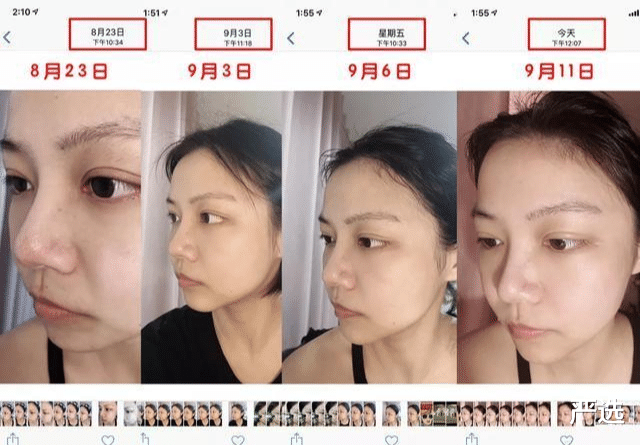 严选|连续打了6年“美白针”的女人，如今怎么样了？网友：难以置信