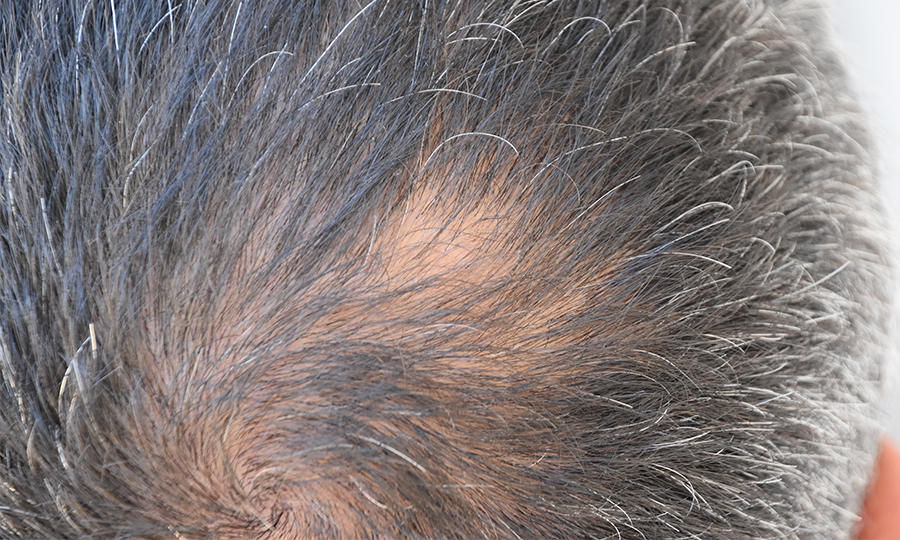 白发|正值青年,便遭白发、脱发!究竟为何?