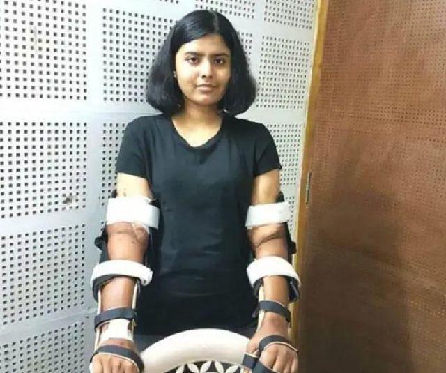 印度女孩因車禍失去雙臂，移植黑人手臂，全身皮膚逐漸變黑瞭！-圖4