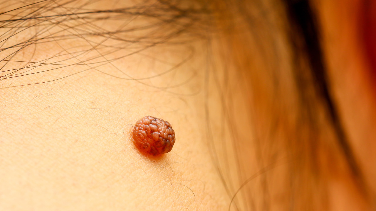 白萝卜|皮肤上的小肉球、小肉疙瘩是什么？不出意外，这4种可能性较大