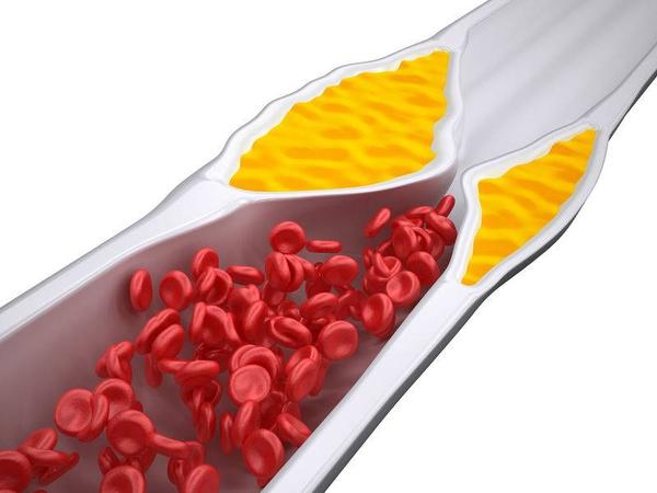 痛经|血管一堵全身都危险！这4个通血管高手，预防血栓，远离脑梗