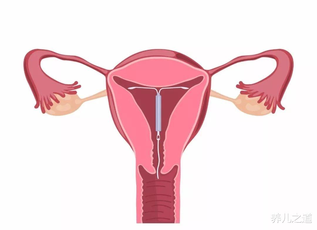 养儿之道|推行三胎后，第一批“取环复通”的宝妈，现在如愿怀上宝宝了吗？