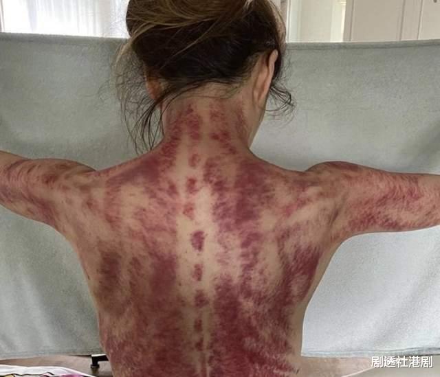 大宅门|天后郑秀文晒刮痧照，背部手臂呈深红色，身体状况令人担心