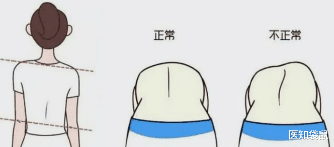 医知袋鼠|脊柱侧弯危害多，100个人就有3个中招！教你一招来判断
