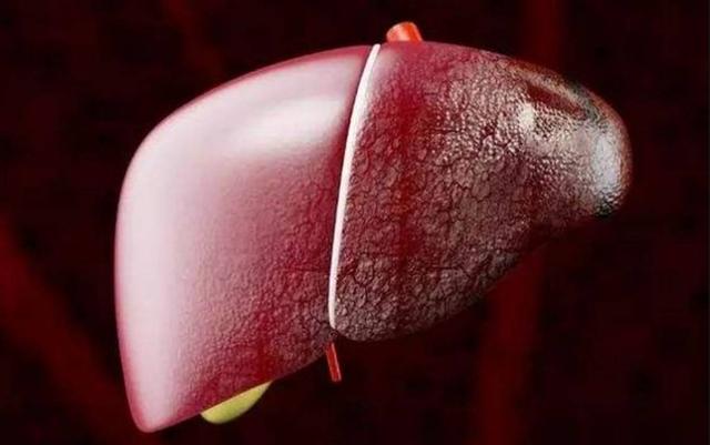 肝脏|肝不好的人,上厕所时会出现3种现象,若你有,劝你最好查肝CT