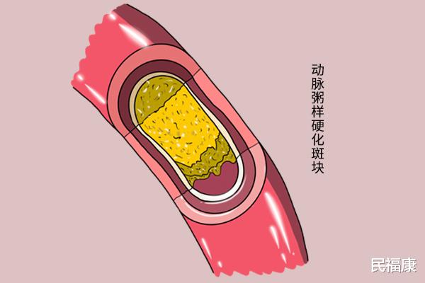 疾病|人老了，是不是都会有颈动脉斑块？查出有斑块，要做什么？