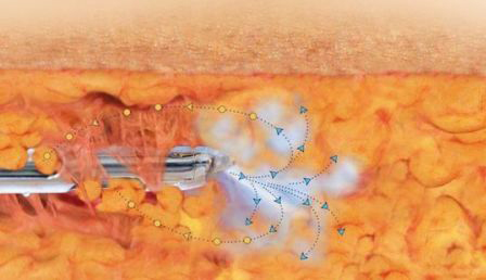 抽脂|104斤女子花费7万元抽脂，抽完大腿凹凸不平上厕所都蹲不了