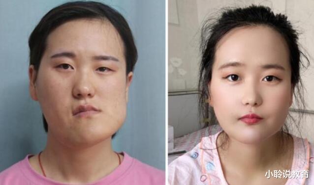 整容|歪脸女孩整容后成“女神”，拒做网红，她的选择让人意想不到