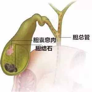 上海宏康|胆囊息肉对身体的危害很大吗?