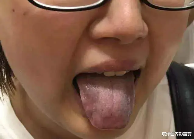 按摩|舌头上出现裂纹是什么原因?舌头有这3种现象,都在反映健康问题