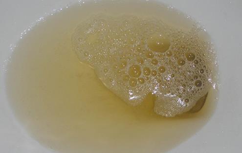 显示器|晨起第一泡尿是肾脏显示器，3种尿液出现，可能是肾脏出了问题！