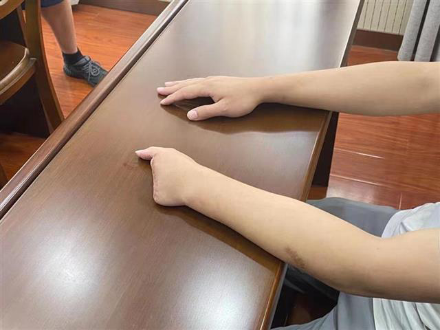 被骗缅甸,小伙拒绝诈骗,被残忍剁下四指!