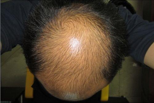 运动|古芳栢草：脂溢性脱发到底能不能自愈？这篇文章告诉你答案！