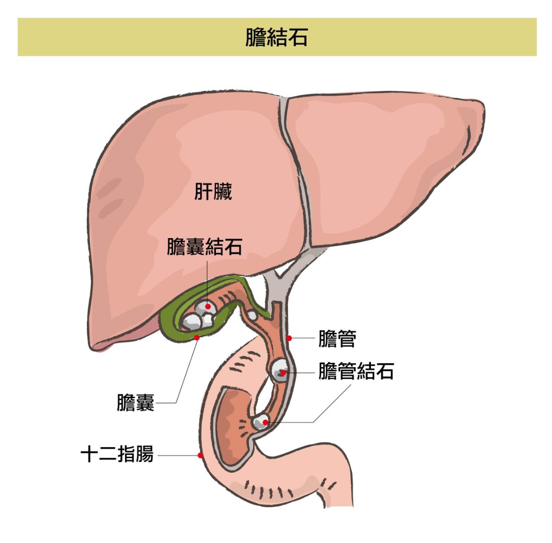 熊猫医学社 胆结石越发普遍，医生：关于胆结石的这几个问题，越早了解越受益