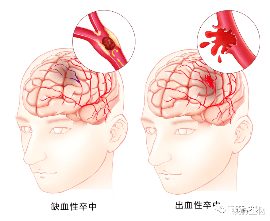 领蔚生物|脑卒中的未来丨干细胞促进神经修复, 改善患者运动功能