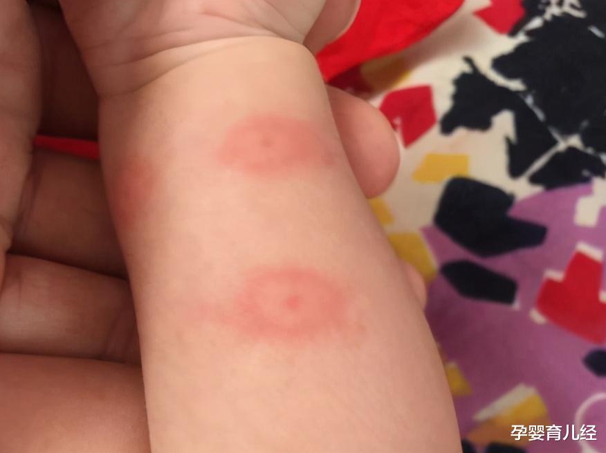 孕婴育儿经|宝宝嘴唇被蚊子咬，秒变“梁朝伟”，夏季防蚊有哪些小妙招？