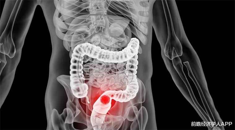 结肠癌|新研究表明：肠道内含有某些细菌，患结肠癌的风险更大