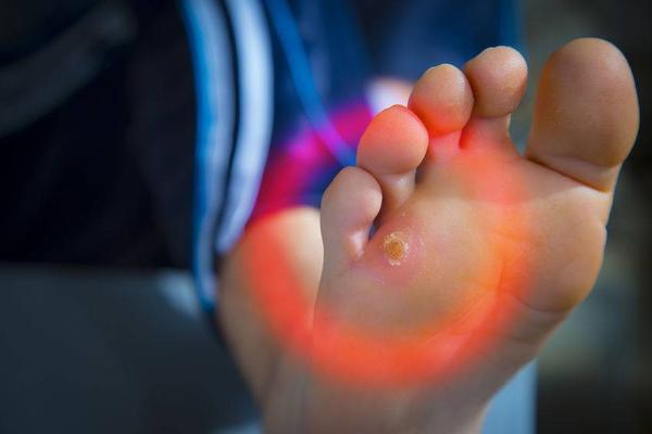 肝脏|血糖高的人，脚上会有这3个异常，可能是糖尿病足来“报到”了