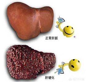 北京一尘中医|唐跃良  肝硬化导致的积水该如何解决？