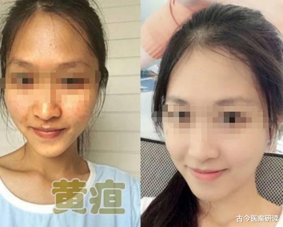 肝癌|50岁男子，每天大便7次，3月后肝癌离世，医生：1物毒素是酒精的十倍