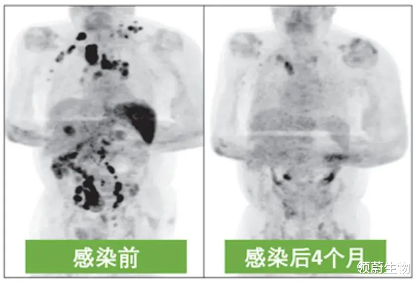 领蔚生物 奇迹案例：激活免疫系统，癌症不药而愈