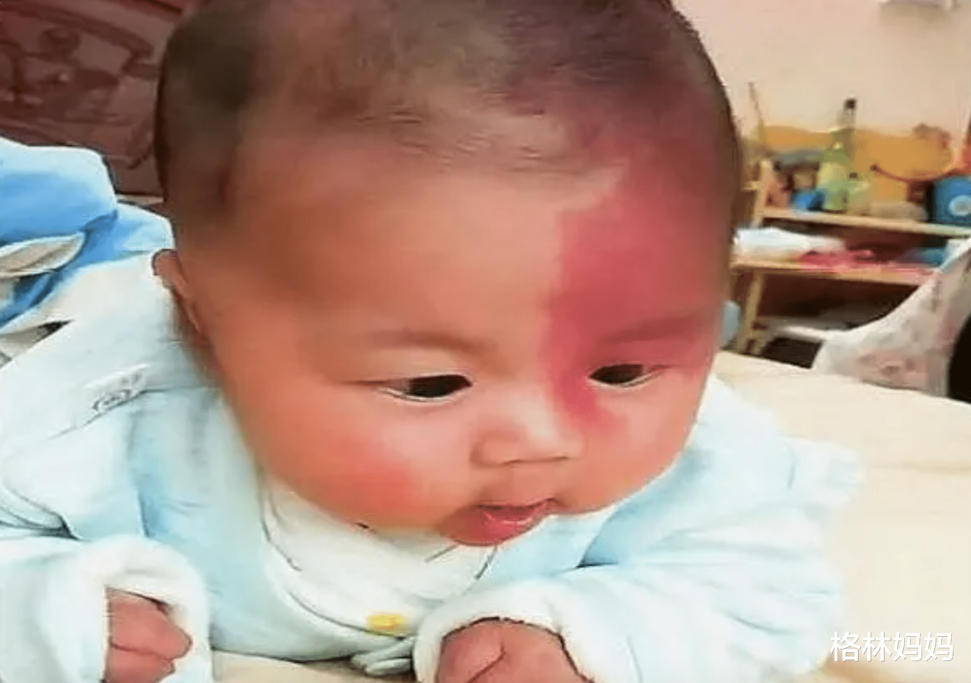 格林妈妈|胎记是怎么来的？产科医生：孕期这2种行为易长胎记，孕妈要避开