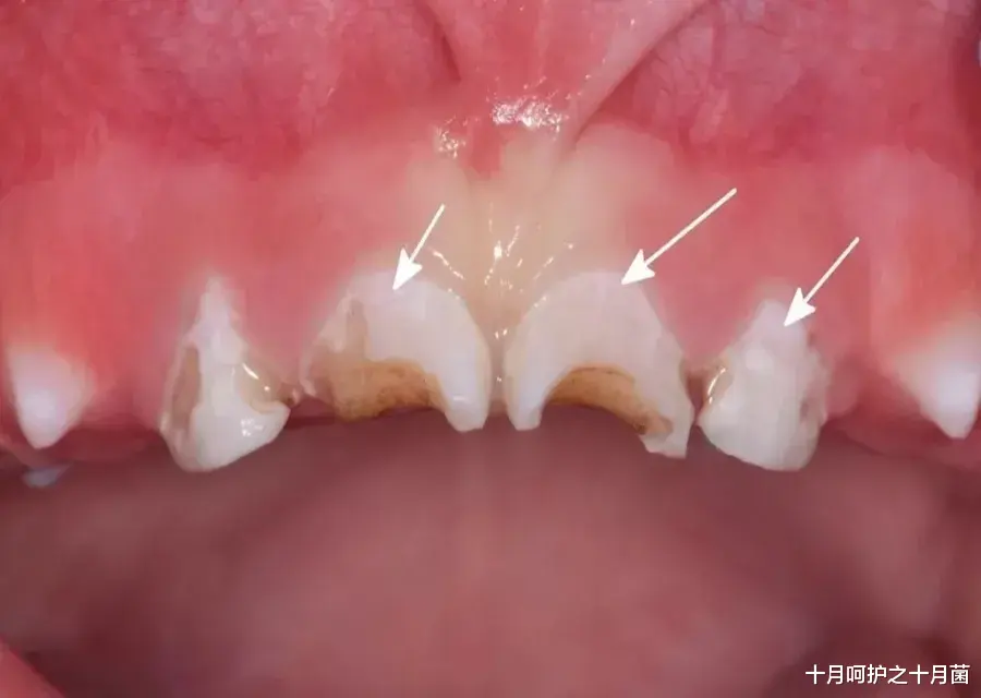 十月呵护之十月菌|不吃糖，孩子却满口烂牙！罪魁祸首竟是它，快看你家有没有