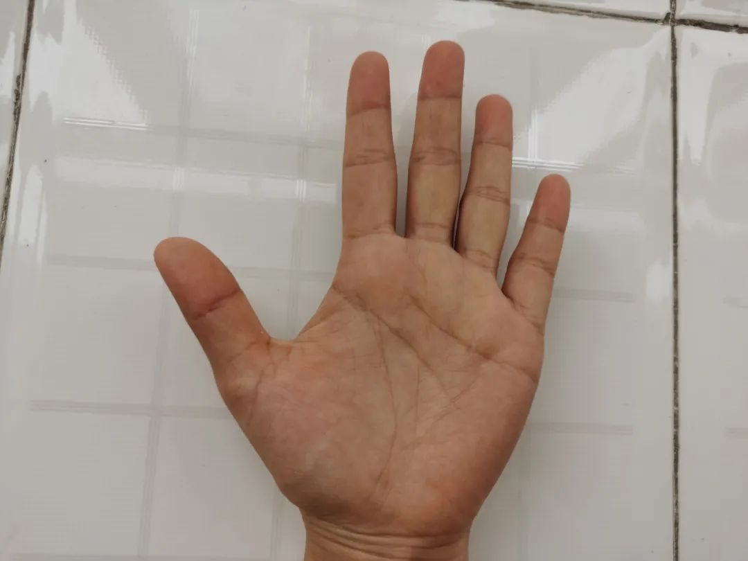 糖尿病|手上有一条“糖尿病线”,可以提前预测糖尿病,具体在什么位置?